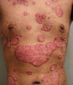 Severe psoriasis affects greater than 10 percent of the body’s surface. Photo credit: Joel Gelfand, MD, MSCE